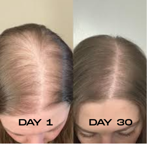 Red Light Therapy Cap for Hair Regrowth Treatments